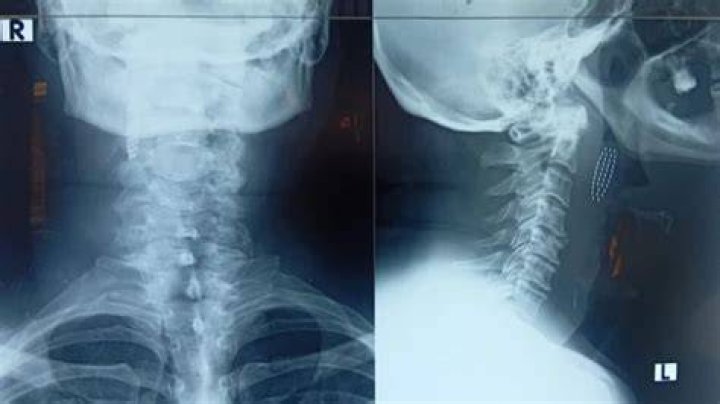 Toothbrush X-Ray