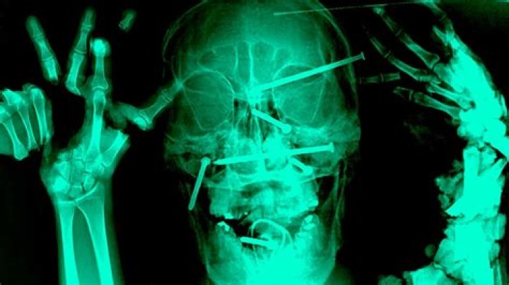 weirdest x-rays fire tongs