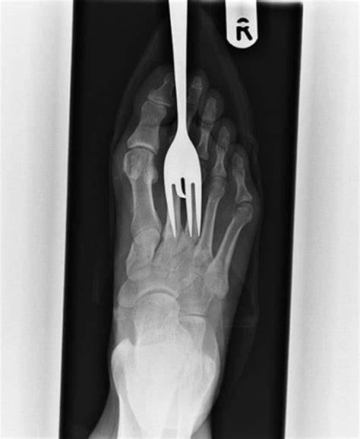 weirdest x-rays foot fork