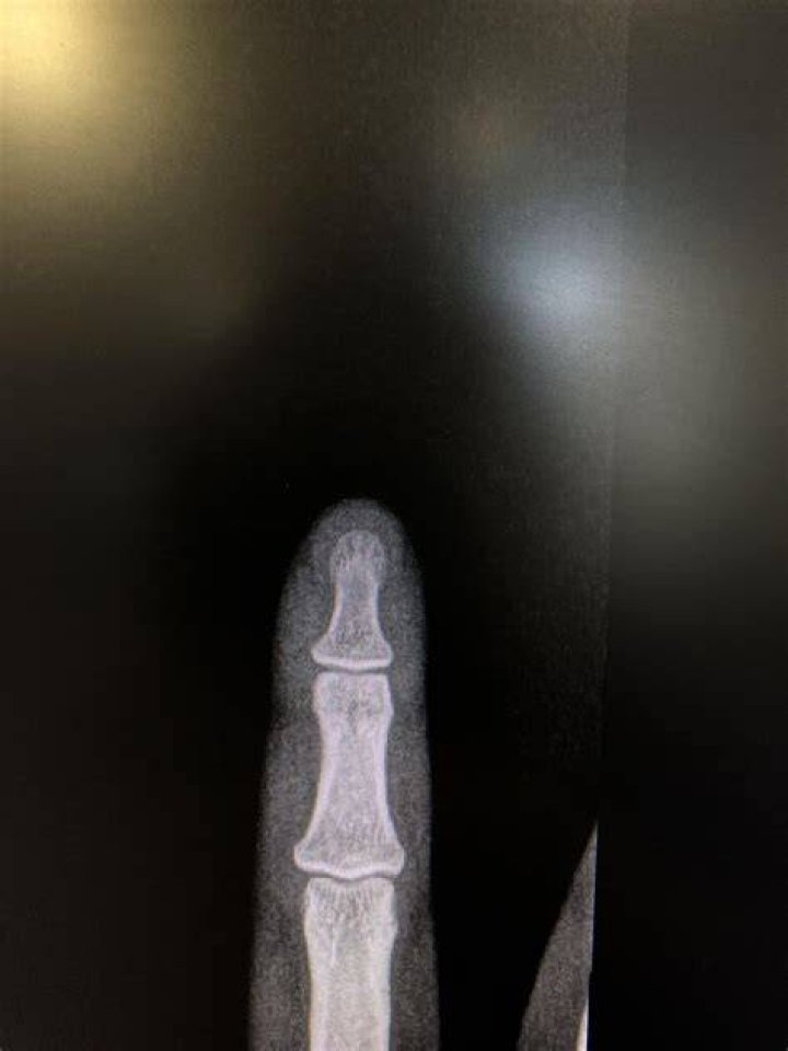 weirdest x-rays lacerated finger