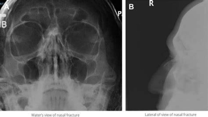 weirdest x-rays nose bullet