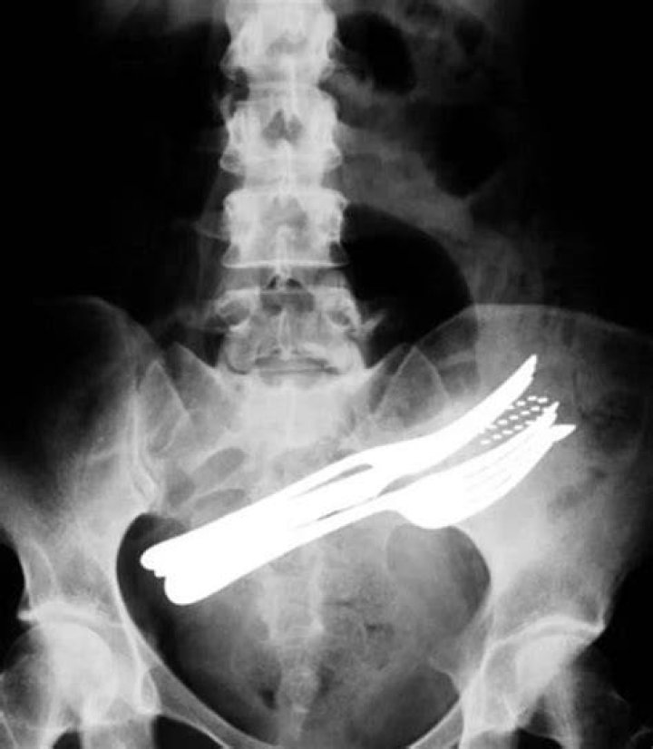 weirdest x-rays spoon knife